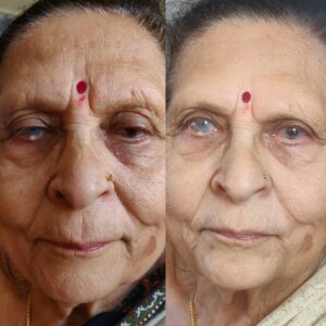 Before & after Facelift session