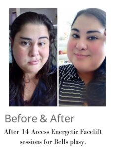 Before & after Energetic facelift sessionon on bells Palsy